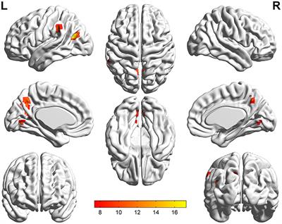 Aberrant Neural Activity in Patients With Bipolar Depressive Disorder Distinguishing to the Unipolar Depressive Disorder: A Resting-State Functional Magnetic Resonance Imaging Study